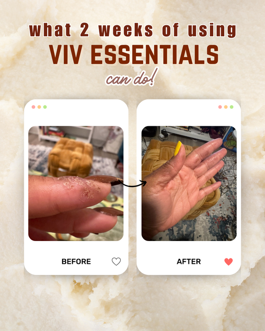 Eczema Starter Relief Bundle