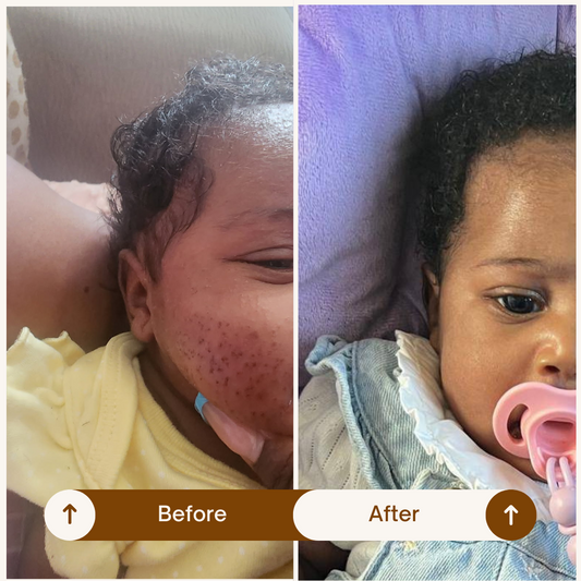 Eczema Relief Complete Care System