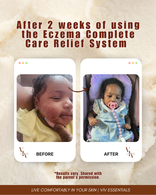 Eczema Complete Care Relief System